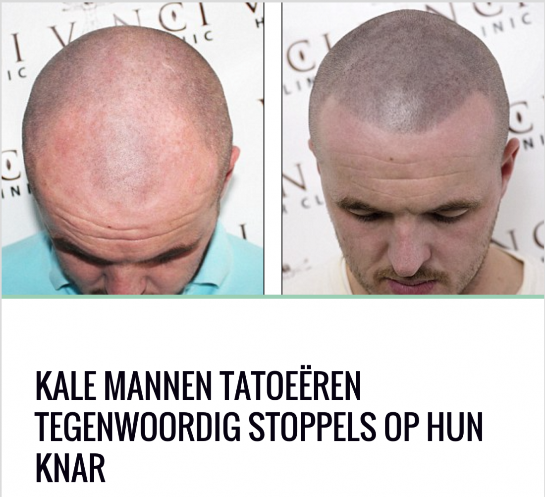 BALLINNN - MICRO HAAR PIGMENTATIE