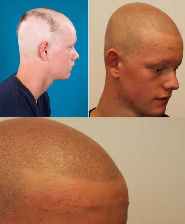 alopecia