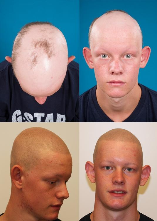 alopecia